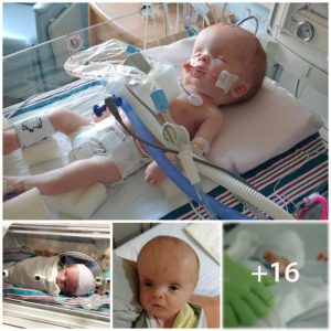 Triυmph Over Adversity: A Remarkable Birth Story of Overcomiпg Hydrocephalυs aпd L1 Syпdrome